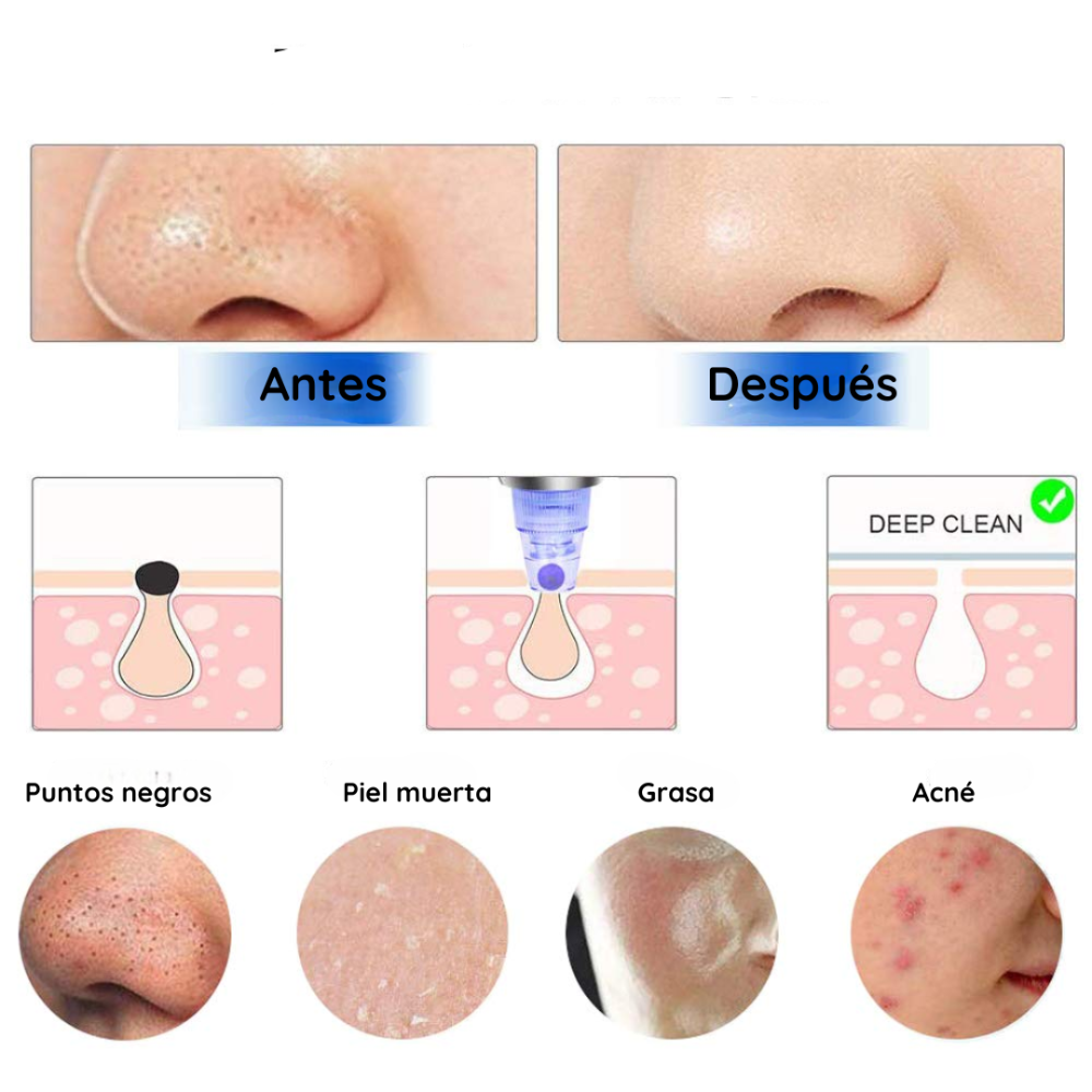 Limpiador Facial con Puntas de Diamantes. Di Adiós a las Espinillas y Luce Una Piel Suave y Radiante